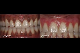 Best gingivitis-treatment-cost in Abu Dhabi