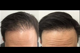Best hair-growth-injections Clinic in Dubai