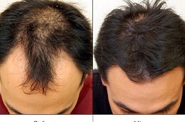 Best hair-growth-injections in Abu Dhabi
