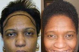 Best hair-transplant for-black females Clinic in Dubai