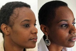 Best hair-transplant for blackfemales in Abu Dhabi