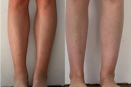 Best how-much-does-calf-reduction-surgery in Abu Dhabi
