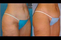 Best is-liposuction-covered-by-insurance clinic in Dubai