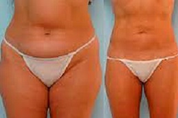 Best is-liposuction-covered-by-insurance in Abu Dhabi