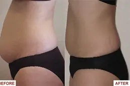 Best laser-lipolysis-cost Clinic in Dubai