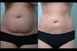 Best laser-lipolysis-cost in Abu Dhabi