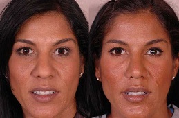 Best nose-tip-plasty-cost in Abu Dhabi