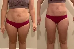 Best post-weight-loss-cost Clinic in Dubai