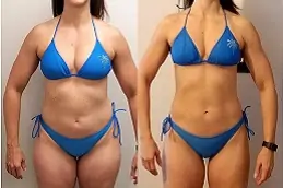 Best post-weight-loss-cost in Abu Dhabi