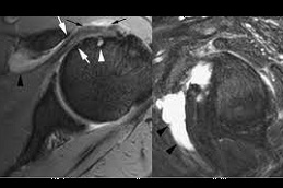 Best prp-injection-for-rotator-cuff-tear Clinic in Dubai