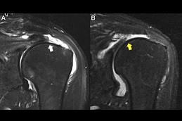 Best prp-injection-for-rotator-cuff-tear in Abu Dhabi