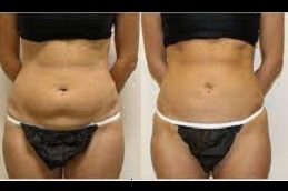 Best tumescent-liposuction-surgery clinic in Dubai