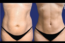 Best tumescent-liposuction-surgery in Abu Dhabi