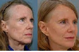 Best vector-facelift-cost Clinic in Dubai