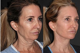 Best vector-facelift-cost in Abu Dhabi