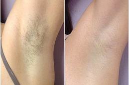 Best which-laser-hair-removal-is-best-for-black-skin Clinic in Dubai