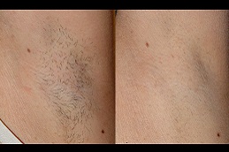 Best which-laser-hair-removal-is-best-for-black-skin in Abu Dhabi