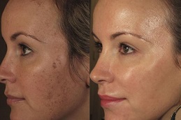 Best which-laser-treatment is for-glowing-skin Clinic in Dubai