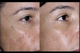 Best which-laser-treatment is for-glowing-skin in Abu Dhabi