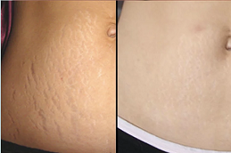 Best which-treatment-is-best-for-removing-stretch-marks Clinic in Dubai