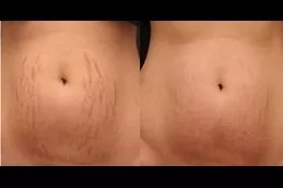 Best which-treatment-is-best-for-removing-stretch-marks in Abu Dhabi