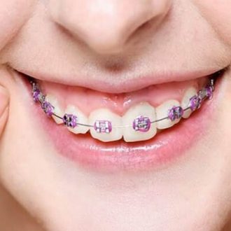 Ceramic Braces Cost in Dubai & Abu Dhabi
