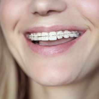 Damon Braces Cost in Dubai & Abu Dhabi