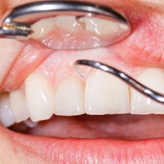 Gum Recession Treatment Cost Dubai & Abu Dhabi