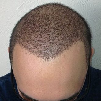 Hair Relocation in Dubai & Abu Dhabi