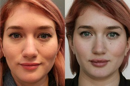 Lip Augmentation Cost in Abu Dhabi