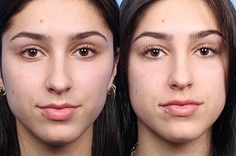 Lip Augmentation Cost in Dubai