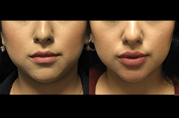 Lip Augmentation Cost in dubai
