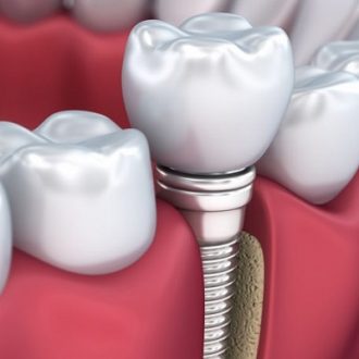 Loose Dental Implants in Dubai & Abu Dhabi