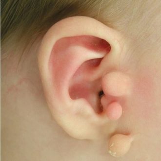 Preauricular Tag Removal Cost Dubai & Abu Dhabi