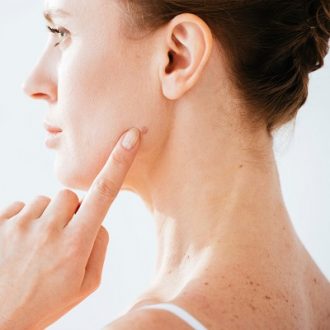 Skin Tags Removal Cost in Dubai