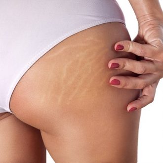 Stretch Mark Laser Treatment Near Abu Dhabi