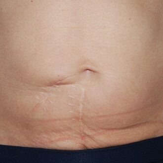 Surgical Scar Removal Pros and Cons in Dubai