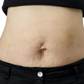 Which Treatment is Best for Removing Stretch Marks?