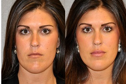 best Lip Augmentation Cost in dubai