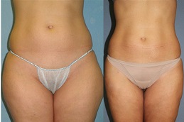 best body-jet-liposuction-cost in dubai