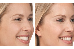 best celebrity-who-done-botox-treatment in dubai