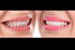 best ceramic-braces-cost in dubai