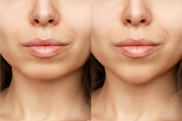 best chin-reduction-cost in dubai