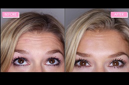 best does-botox-work-for-wrinkles-around-the-mouth in dubai