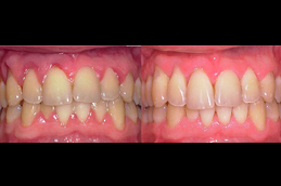 best gingivitis-treatment-cost in dubai