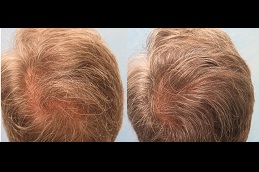 best hair-growth-injections in dubai