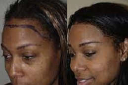 best hair-transplant-for-black females in dubai