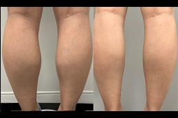 best how-much-does-calf-reduction-surgery in dubai