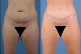 best is-liposuction-covered-by-insurance in dubai