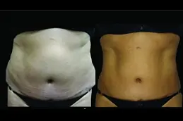 best laser-lipolysis-cost in dubai